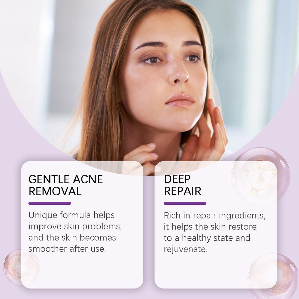 Azelaic Acne Care Cream Gently Moisturizes And Improves Facial Acne Brightening And Moisturizing Cream