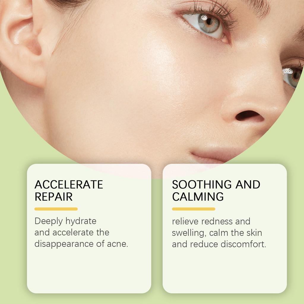 Ouhoe For Acne Prone Skin With 216 Patches For Effective Blemish Coverage And Skin Care