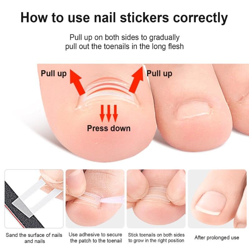 10 Pieces Ingrown Toenail Correction Kit Flexible Toenail Strips Toenail Straightener Thick Toenail Recovery for Adults