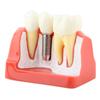 1pc Resin Dental Demonstration Tooth Model Implant Analysis Crown Bridge for Dentist