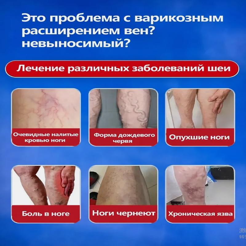 Vein Health Patch, Remove Leg Pain And Swelling Varicose Blood Vessels Earthworm Leg Vein Health Patch