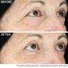 Strivectin Hyperlift Eye Instant Eye Fix For Bags  Lines   Crepiness .34 Oz