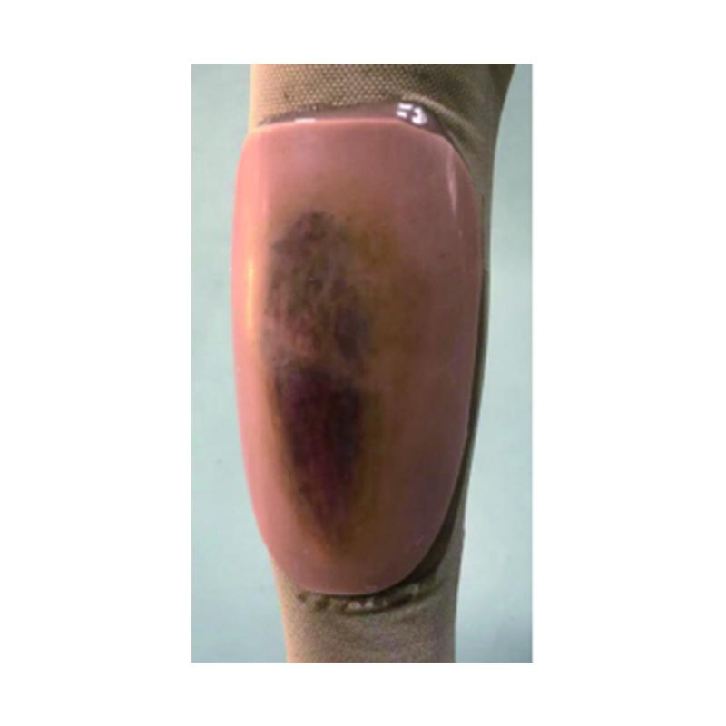 AWR Wearable Forearm Fracture Kit