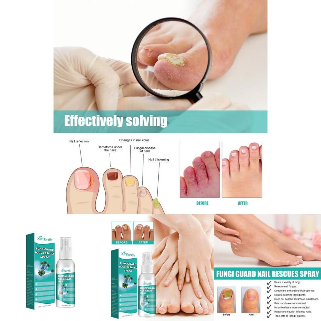 Spray de Soin des Ongles Ximonth Pour des Ongles Plus Forts et Élimination des Odeurs 30ml Solution Efficace