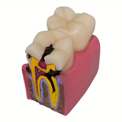 6 Times Dental Caries Model Disease Teeth Dental Model for Dental Demonstration Model Dentist Teaching Dental Lab Oral Research
