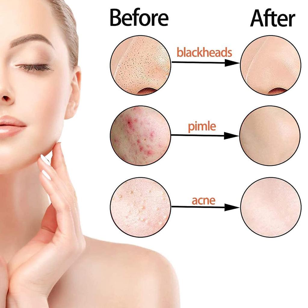 Blackhead Removal Tool BetterJonny Stainless Steel Acne Remover Cleaning Tool Professional Acne Removal Kit with Storage Includes Acne Blackhead and