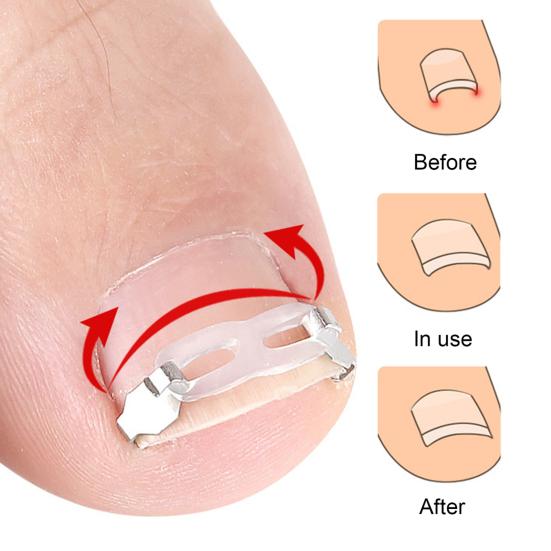 Yousheng Sada korektoru zarostlého nehtu pro zakřivený nehet Nerezová ocelová pancéřová spona Narovnávač nehtu na noze Nástroj na zarostlý nehet
