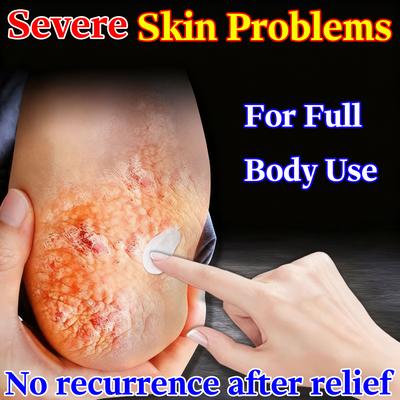 Gentle Skin Problem Gel - Herbal Extracts Relieves Eczema Dermatitis & Redness