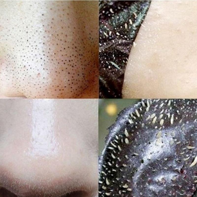 20 szt. Pasta do nosa z zaskórnikami Czyste pory Usuwają granulki tłuszczu, blokują pory, zaskórniki i Whitehead