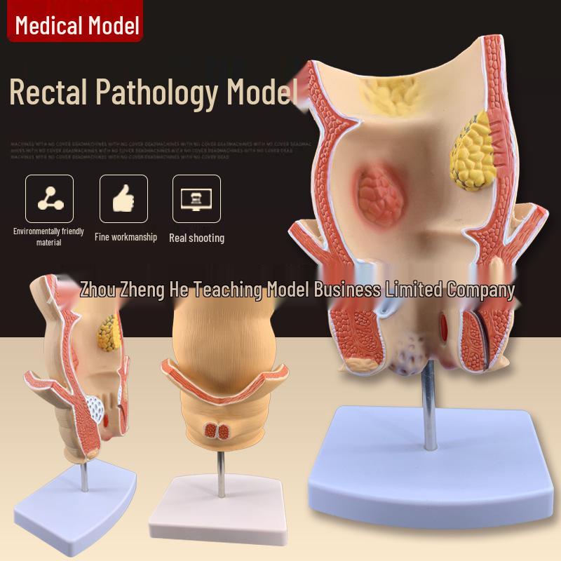 Rectal Pathology Teaching Model: Hemorrhoids & Anal Lesions Specimen for Medical Education 12x12x19 cm