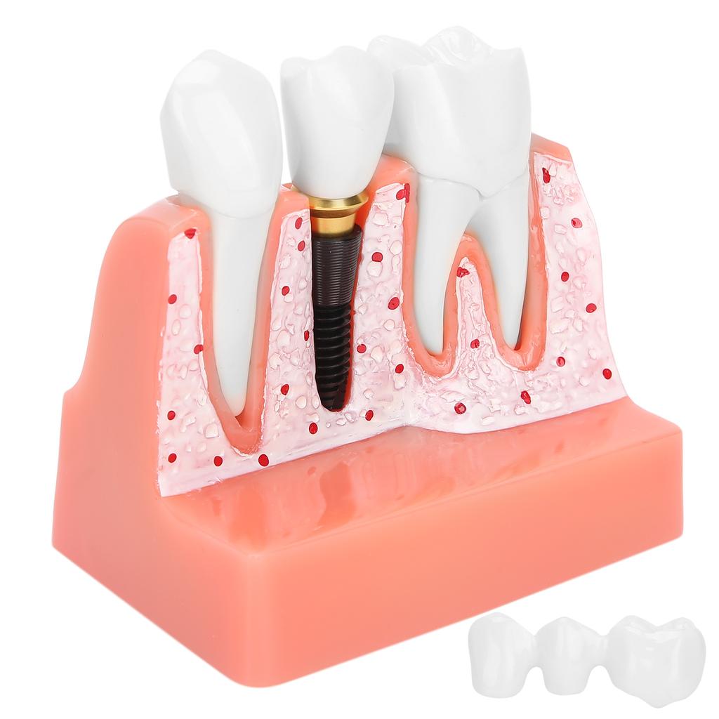 Model zubů Analýza zubního implantátu Demonstrační model korunkového můstku Model zubu