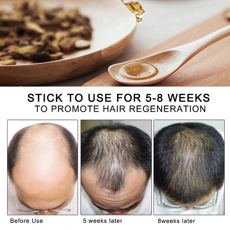 ARTISCARE Hair Growth Essence Spray 30mL Anti Hair Loss Nourish Roots Hair Care