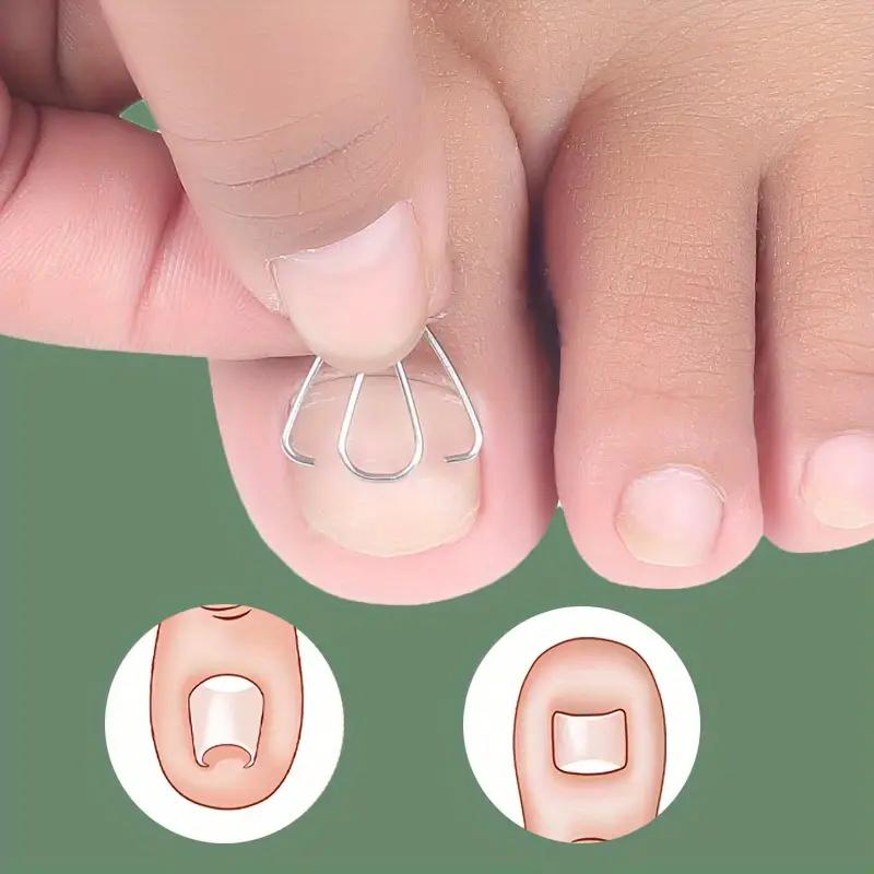 Nagelkorrekturdraht, Gerät zur Korrektur eingewachsener Nägel, Nagelschneiden, Korrekturdraht für eingewachsene Nägel, Zehennagelkorrekturhaken
