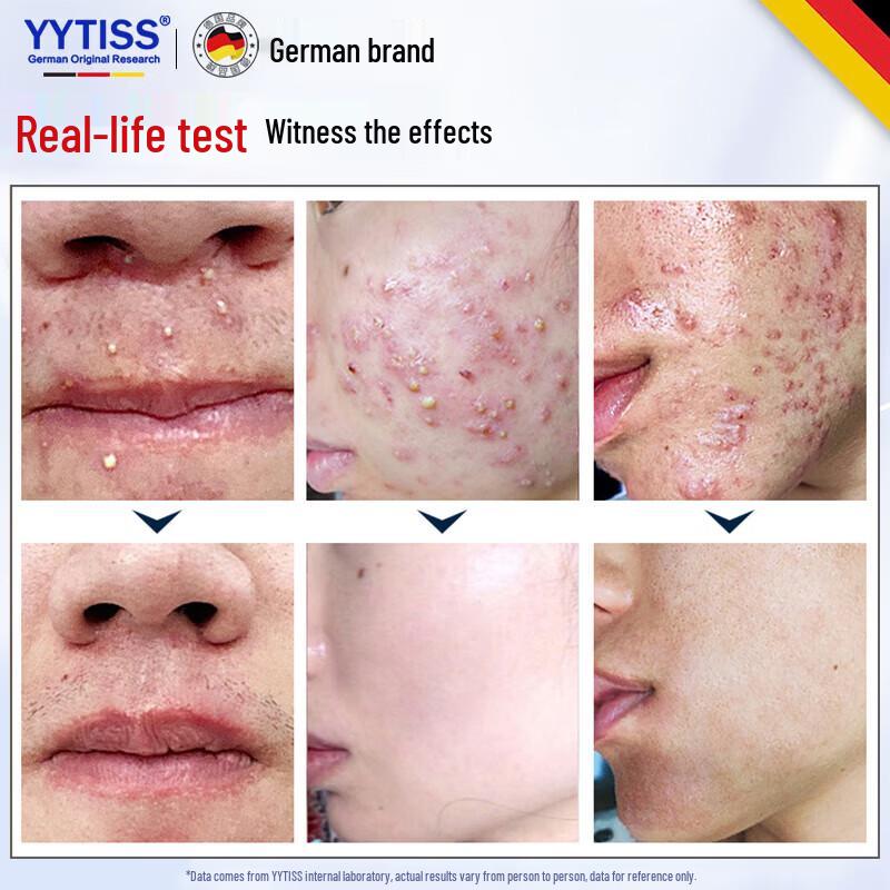 YYTISS Acne Treatment Cream