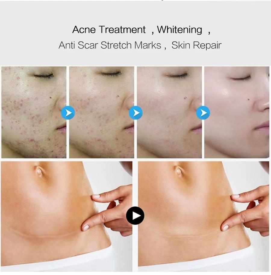 Creme Haut Wundcreme Brennen Verblassen Creme Chirurgie Reparatur Narbe Hautpflege Hautaufheller Creme Crema Para Manchas De La Cara