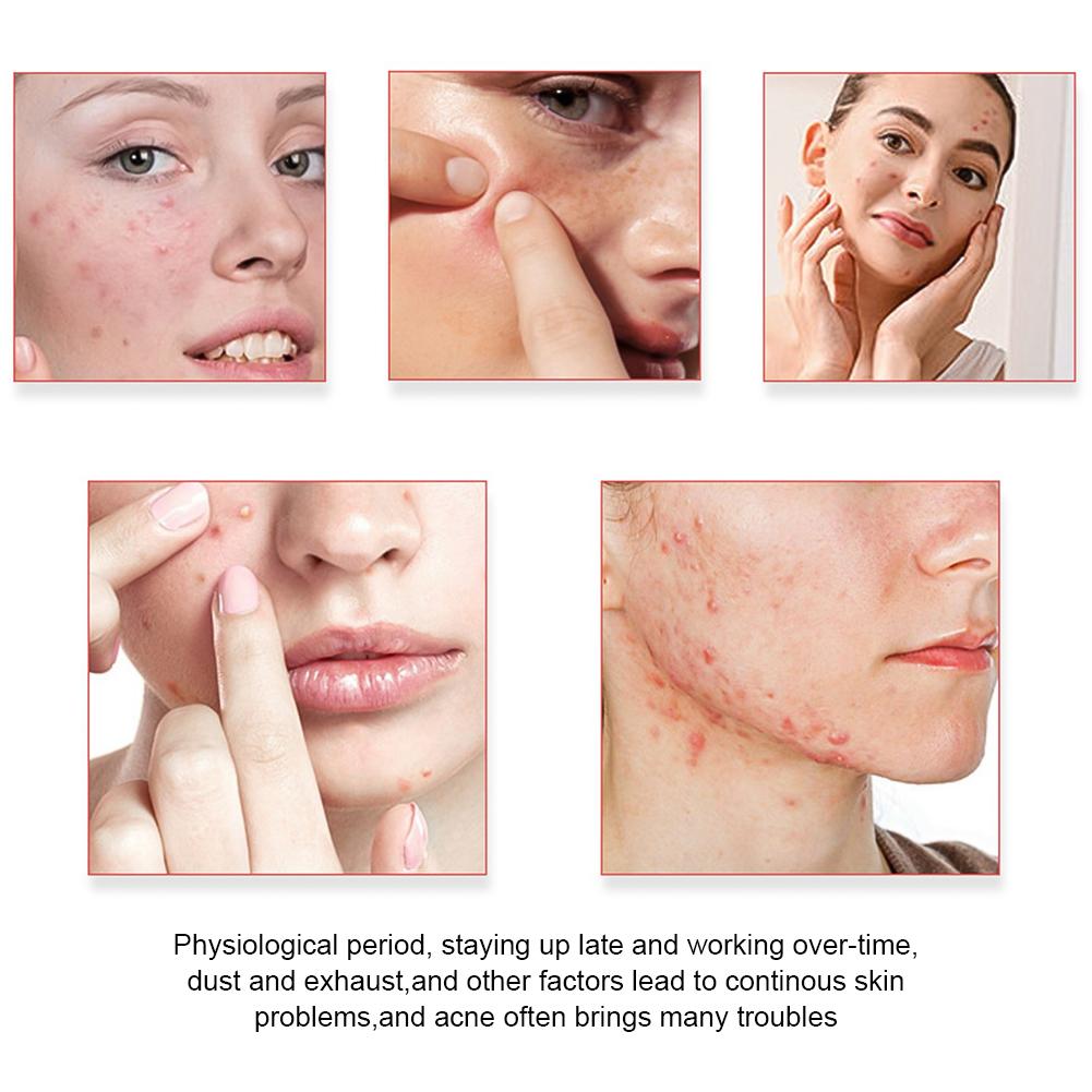 200Pcs Acne Patches Fade Blemishes Pimple Marks Closed Acne Blemishes Hydrocolloid Star Heart Shaped Cover Acne Pimple Patch