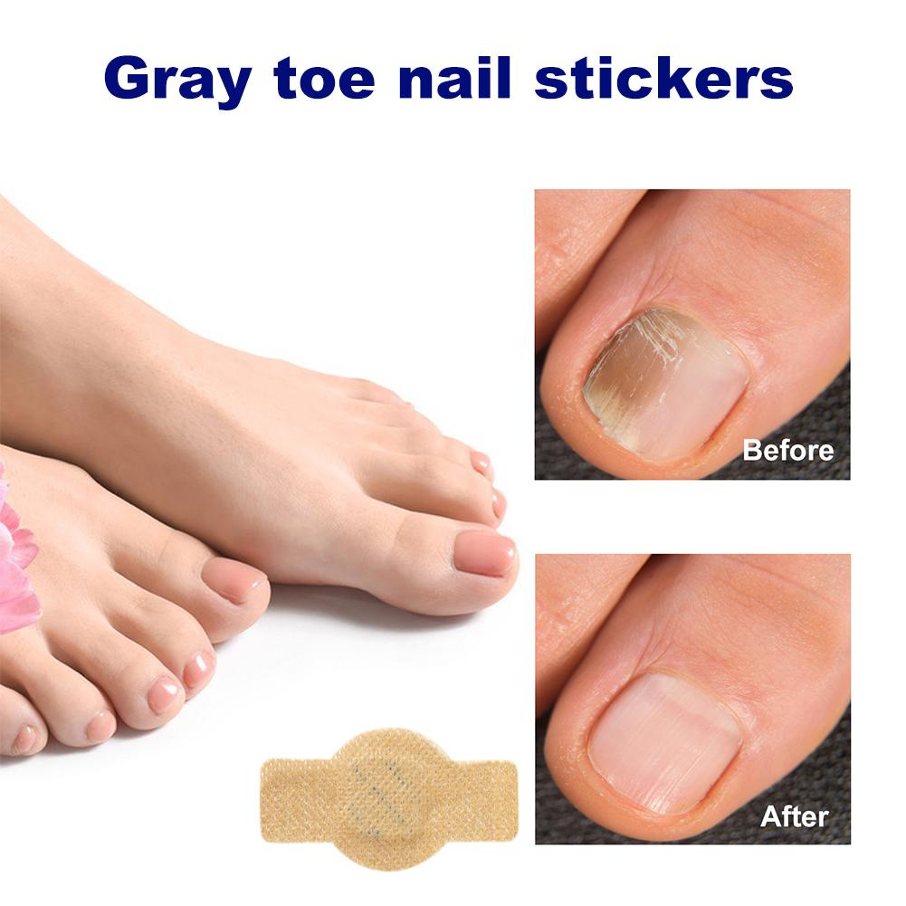 Szary plaster na paznokieć u stopy Plaster do naprawy paznokci grzybiczych Plaster korygujący wrastające paznokcie Pielęgnacja paznokci u stóp Plaster do leczenia zanokcicy 1/5 opakowań