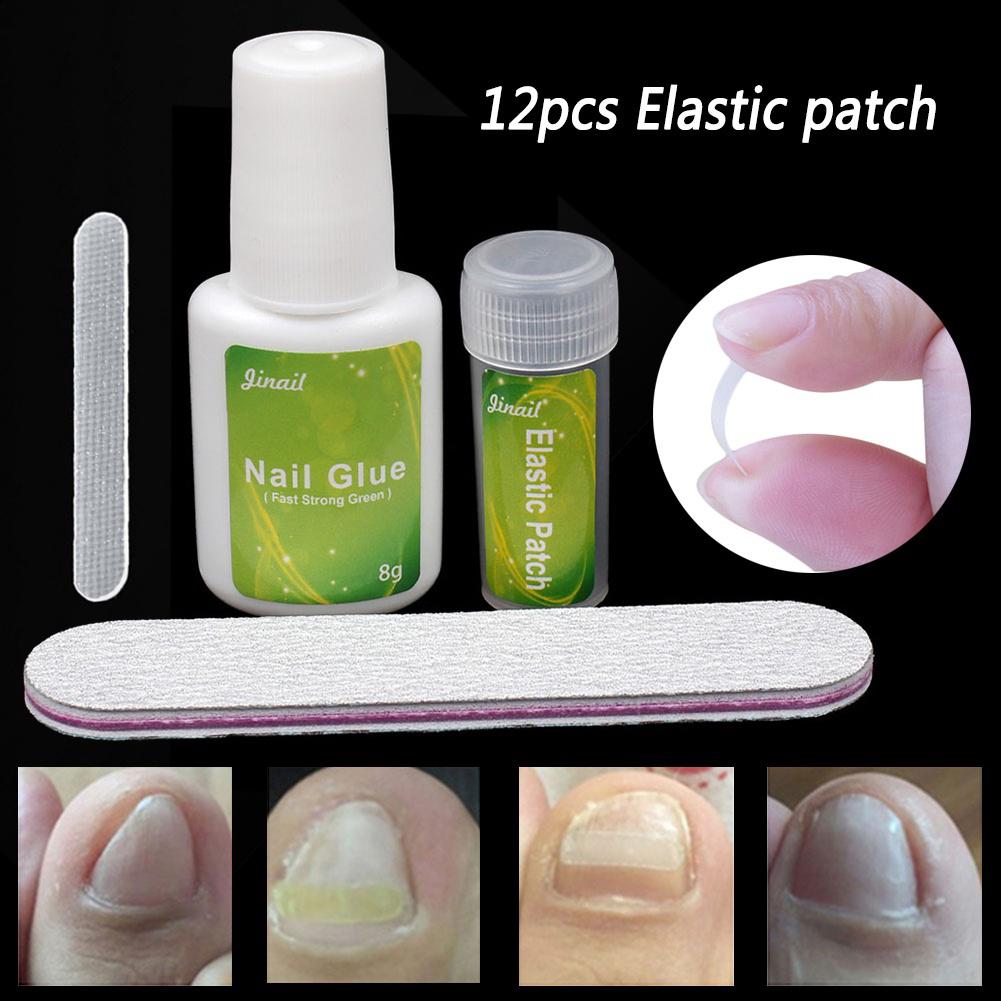 Clinging 12Pcs Ingrown Toenail Correction Pedicure Tool Elastic Patch Straightening Clip