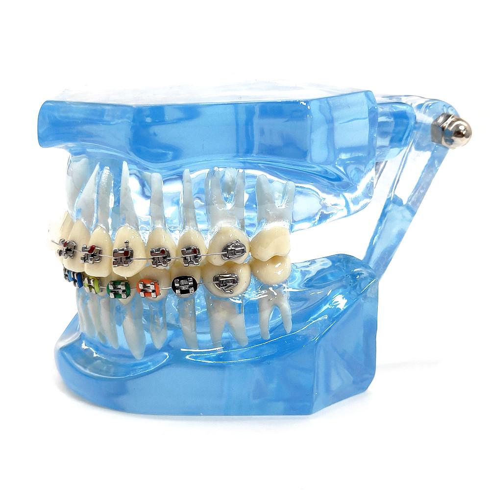 Dental Orthodontic Teeth Tooth Model 4 Kinds Brackets Ceramic and Metal Brackets for Patient Communication Dental Study Model