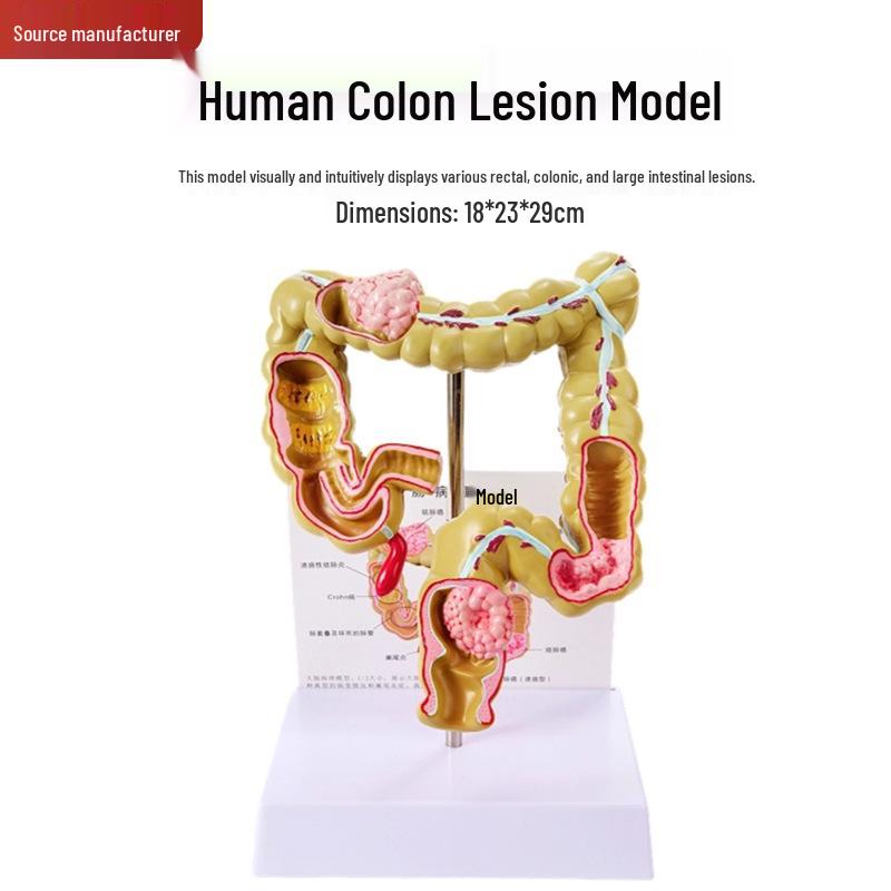 Large Intestine Pathology Model: Human Colon & Intestinal Disease Simulation