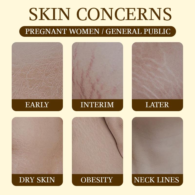 120ml Stretch Marks Oil