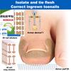 Ingrown Toenail Toe Correction Stickers Paronychia Treatment Recover Corrector Patches Feet Care Paronychia Treatment Recover