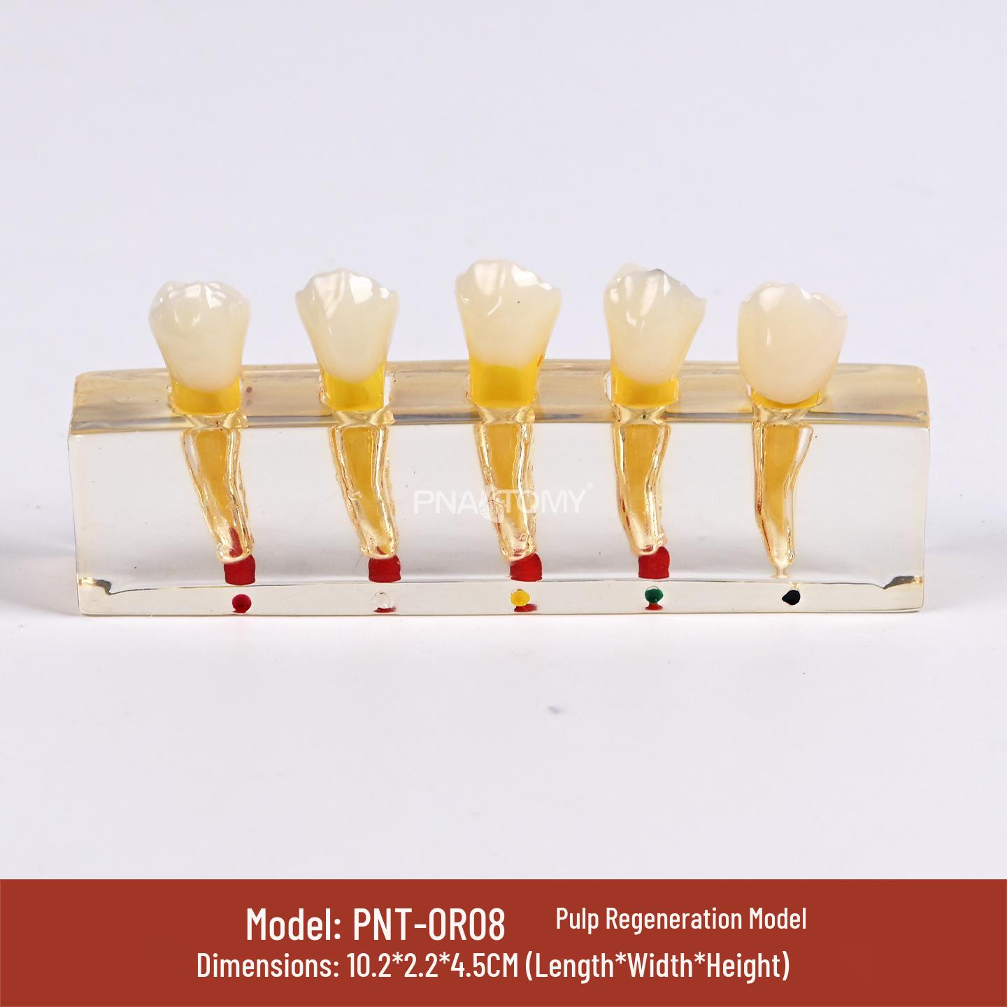 5-Piece Dental Pathology Model: Caries, Lesion, Pulp Necrosis, Root Apex PVC Material