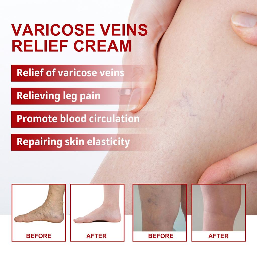 Varicose Veins Paste, 2024 New Varicose Veins Paste For Legs,Ointment Paste Against Spider Rice, Spider Rice Remove Paste.