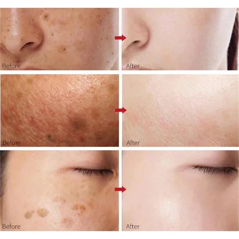 Crème blanchissante efficace pour les taches de rousseur, élimine le mélasma, atténue les taches brunes, hydrate, éclaircit la peau du visage, produit de soin