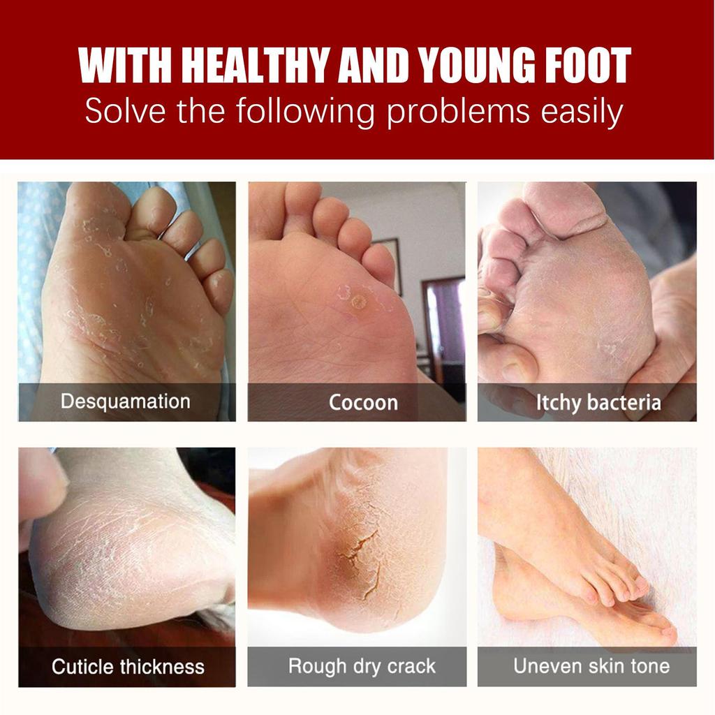 Jaysuing Fruit Acid Exfoliating Foot Mask Gently Exfoliates, Softens Calluses, Rejuvenates Skin, Moisturizes and Moisturizes Beautiful Feet