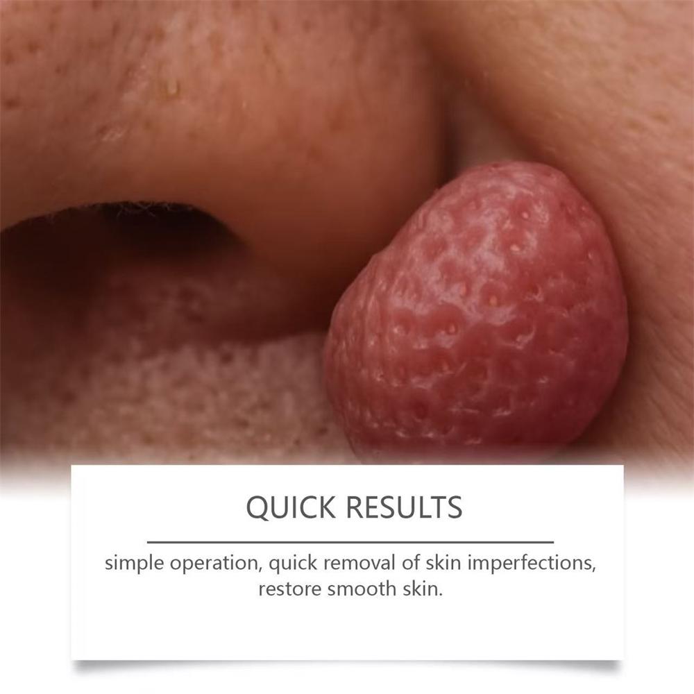 Newly Upgraded Blue Laser Pen for Skin Care, Gently Caring for Every Inch of Your Skin