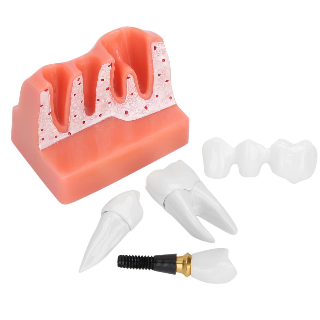 Model zubů Analýza zubního implantátu Demonstrační model korunkového můstku Model zubu