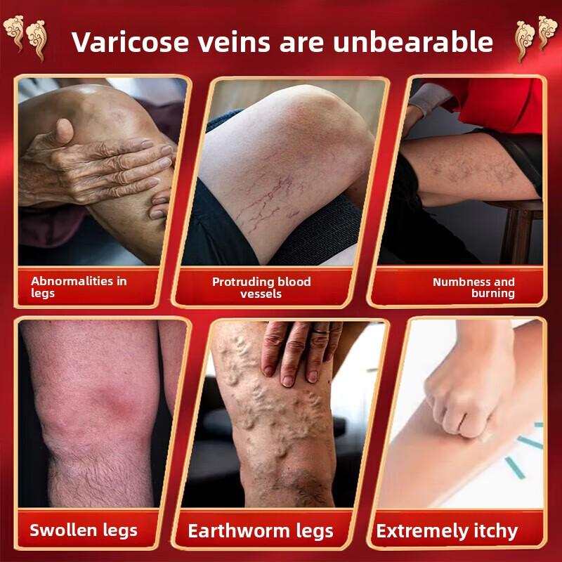 Herbal Varicose Veins Ointment - Relieves Tension Natural & Skin-Friendly