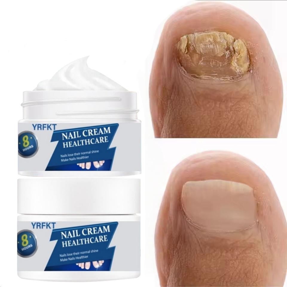 Nail Care Cream, Safe and Gentle for Repairing Nails On Hands, Feet, and Toes, Removing Nail Fungi, Repairing and Caring for Paronychia