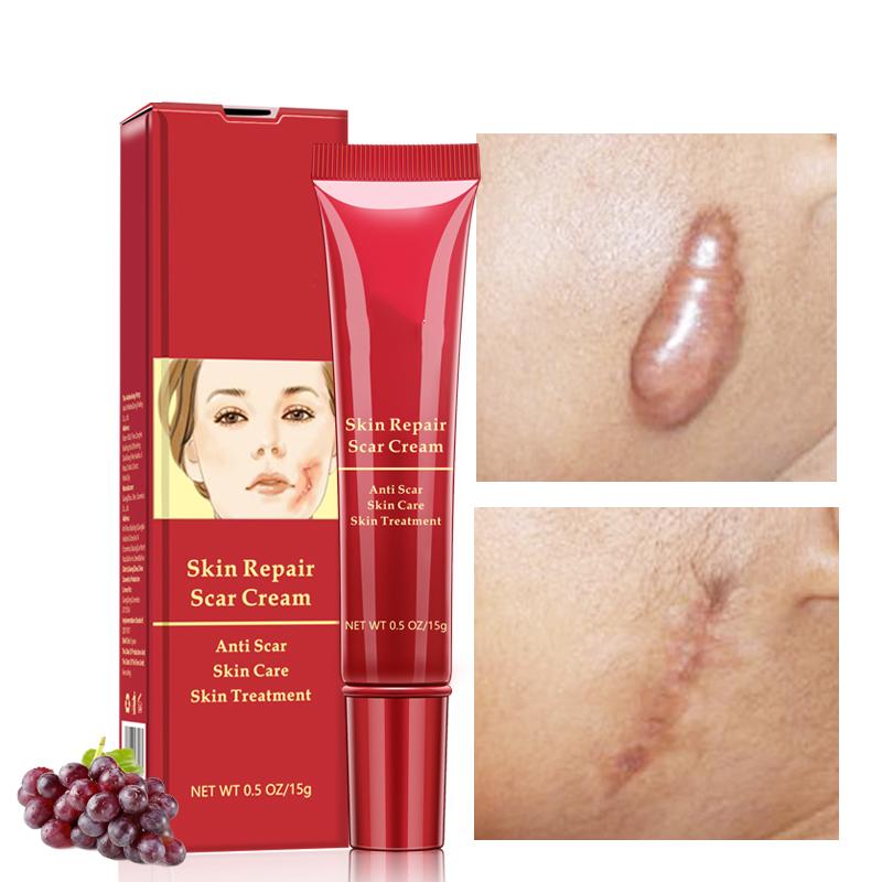 Scar Removal Cream for All Skin Types - Reduces Scars, Acne Marks, and Stretch Marks