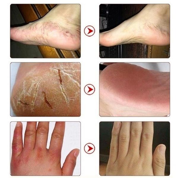 La più recente crema idratante riparatrice per la pelle delle mani e dei piedi anti-screpolature per piedi screpolati, secchi e screpolati, crema per i piedi riparatrice del tallone