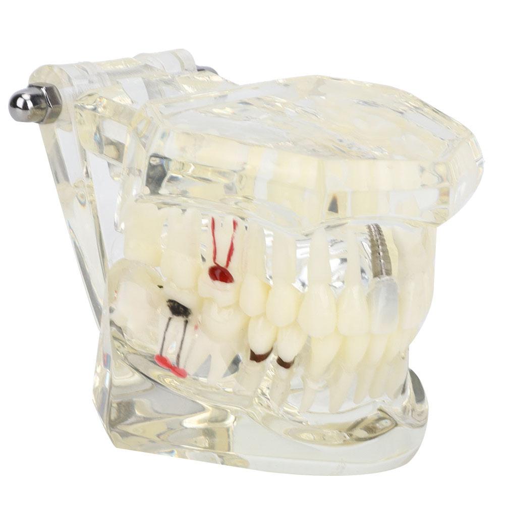 Modello Trasparente di Denti Malati da Laboratorio Studio di Anatomia Patologica Modello Dentale Didattico