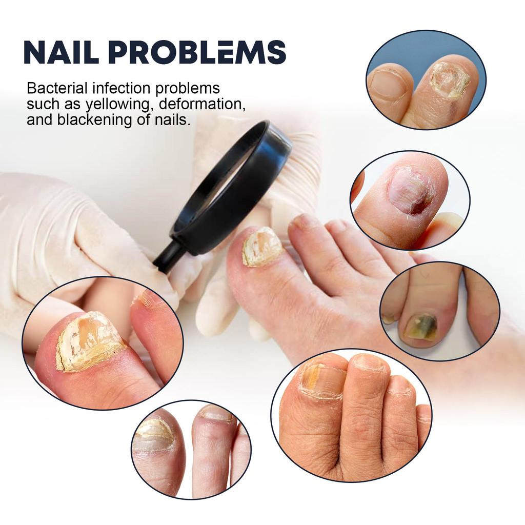 Ximonth Nail Care Spray Nourishing Moisturizing Solution For Strong Healthy Nails 30ml