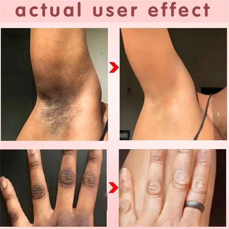 Aufhellungscreme, private Teile, Achsel-Bleaching-Serum, Aufhellung des Gesäßes, Knie, Aufhellung der inneren Oberschenkel, intime Teile, dunkle Melanin entfernen