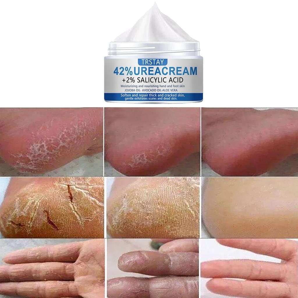 Salicylic Acid Urea Foot Moisturizer Brightens Skin Tone, Moisturizes, Lightens Dullness, and Firms Skin