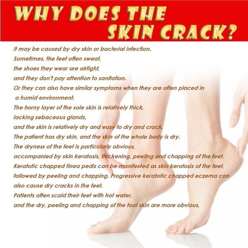 Jaysuing Moisturizing Foot Cream For Deep Hydration And Skin Repair For Cracked Dry Feet