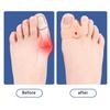 2Pcs Silicone Gel Double Ring Thumb Corrector Bunion Foot Toe  Protector Separator Finger Straightener Adjuster