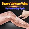 Varicose Veins Cream - Relief for Leg Swelling & Pain, Improves Blood Circulation, Thai Herbal Formula, External Care Ointment 55g