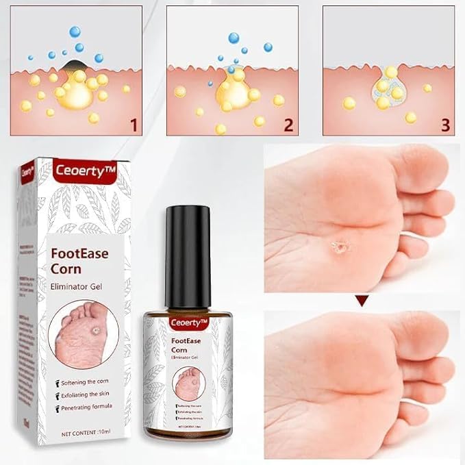 Foot Corn Removal Gel – Fast-Acting