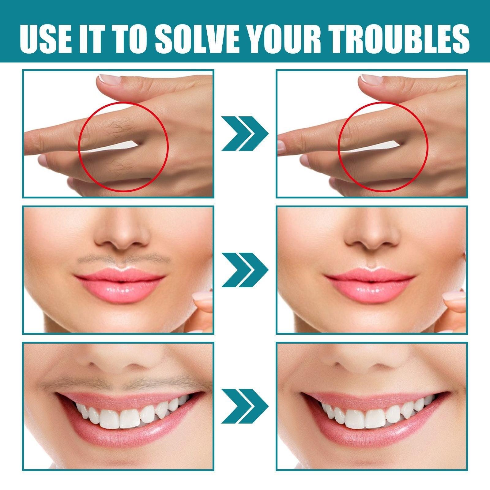 Удаление волос на лице — фото 5