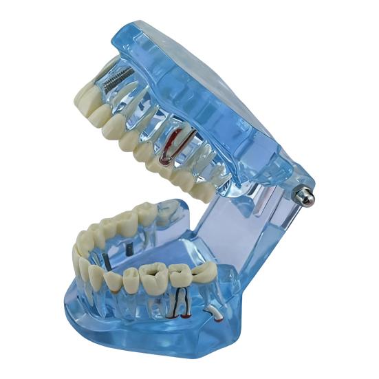 Dental Implant Model Teaching Aid for Dentist Student School Removable Teeth