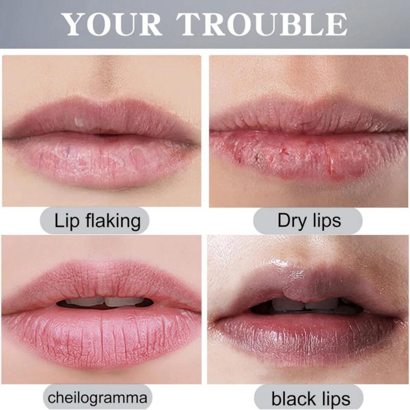 Lippenakne-Creme, Fordyce-Flecken - Lippenakne, Spendet Feuchtigkeit, Verbessert Trockenheit