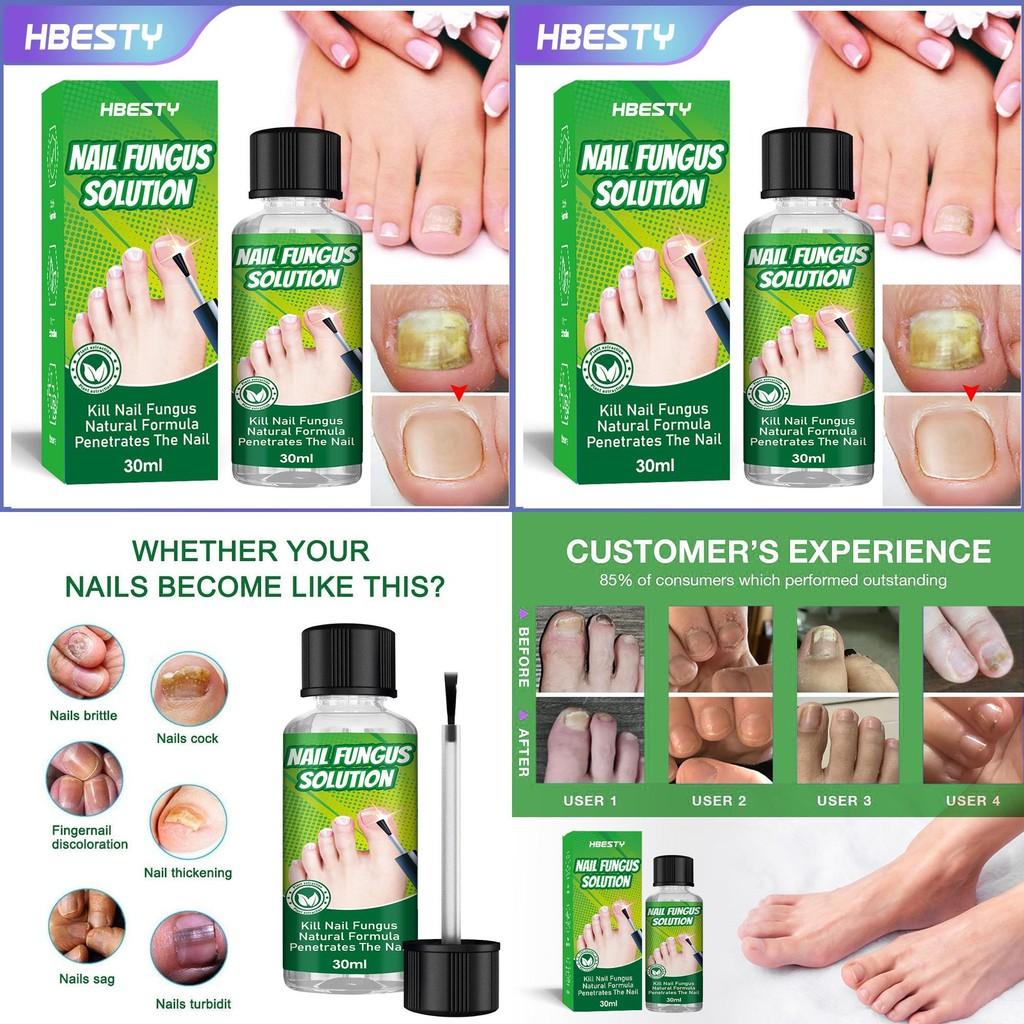 Hbesty Herbal Nail Fungus Treatment Liquid For Effective Foot Care And Healing