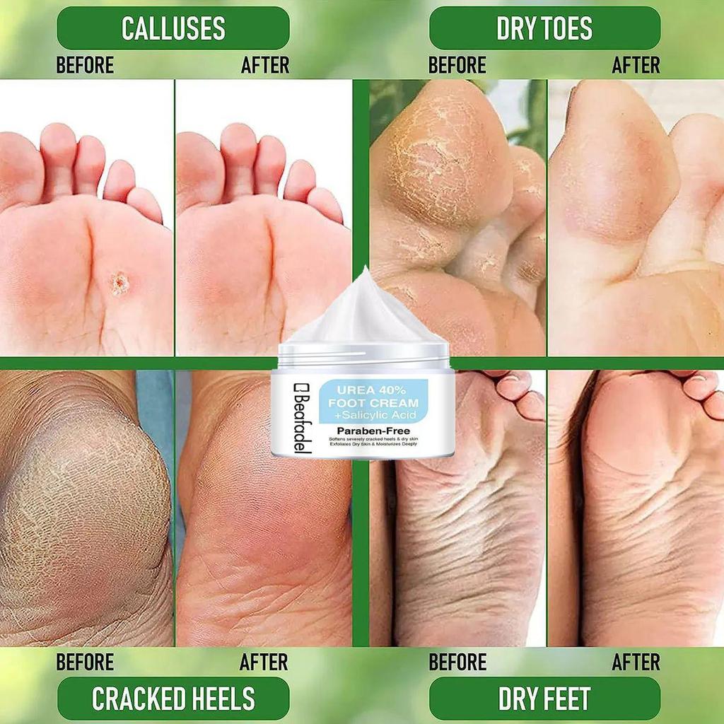 Chapped Feet & Feet Repair Cream er mild og ikke-irriterende, fukter og nærer huden