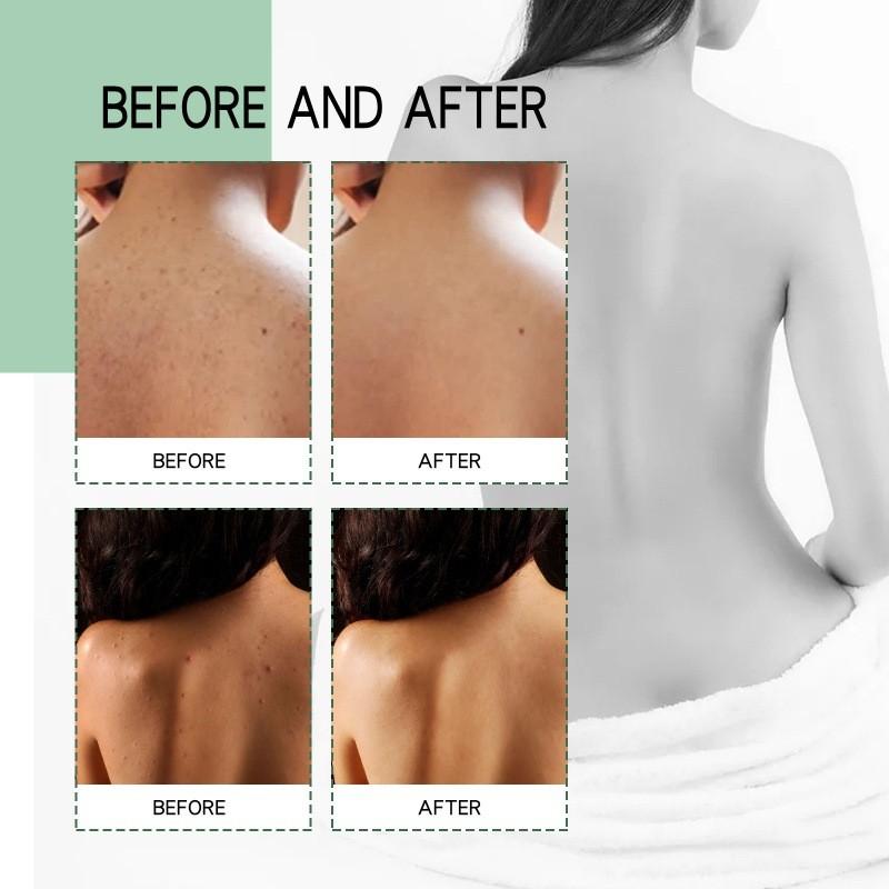 Jaysuing Back Acne Repair Spray For Effective Blemish Treatment And Skin Smoothing